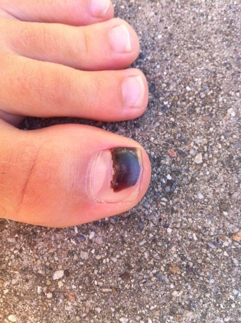 Black Toenails Is an injury that is totally preventable so why is it  something many athletes aspire to achieve? - Running News Daily by My BEST  Runs - My BEST Runs -